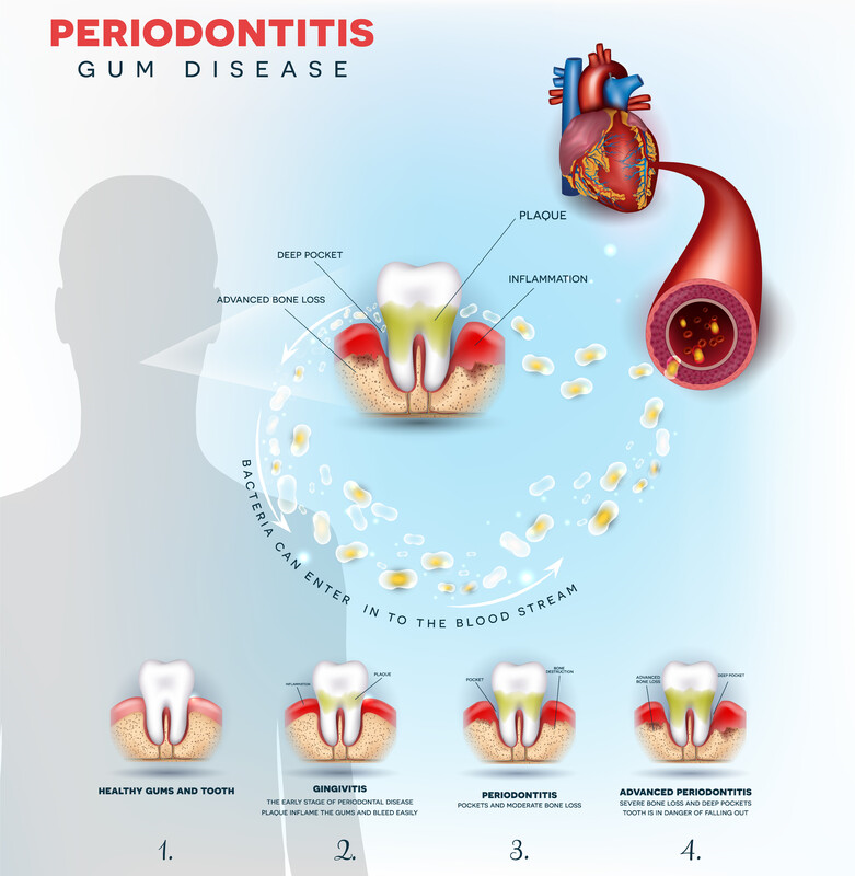 Periodontitis